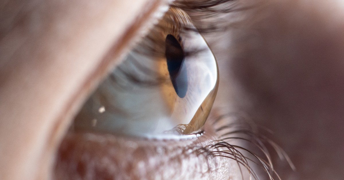 Keratoconus - Causes, Symptoms and Treatment