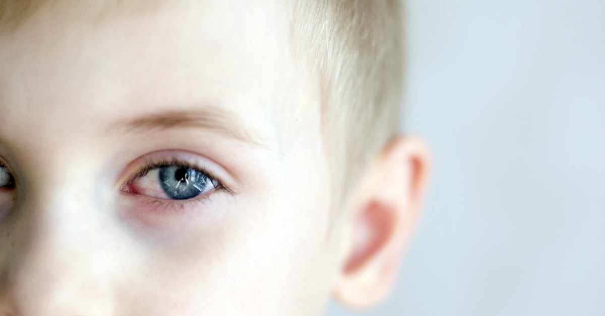 Conjunctivitis in Children - Symptoms and Treatment