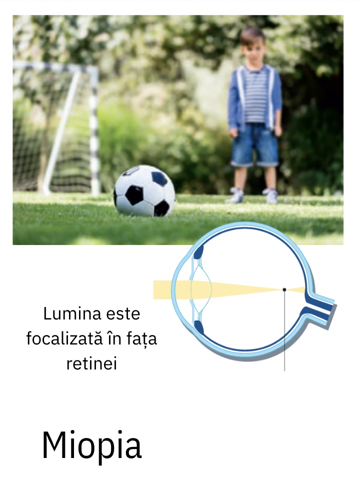 Myopia - refractive disorder