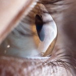 Keratoconusul-afectiune-oculara-progresiva